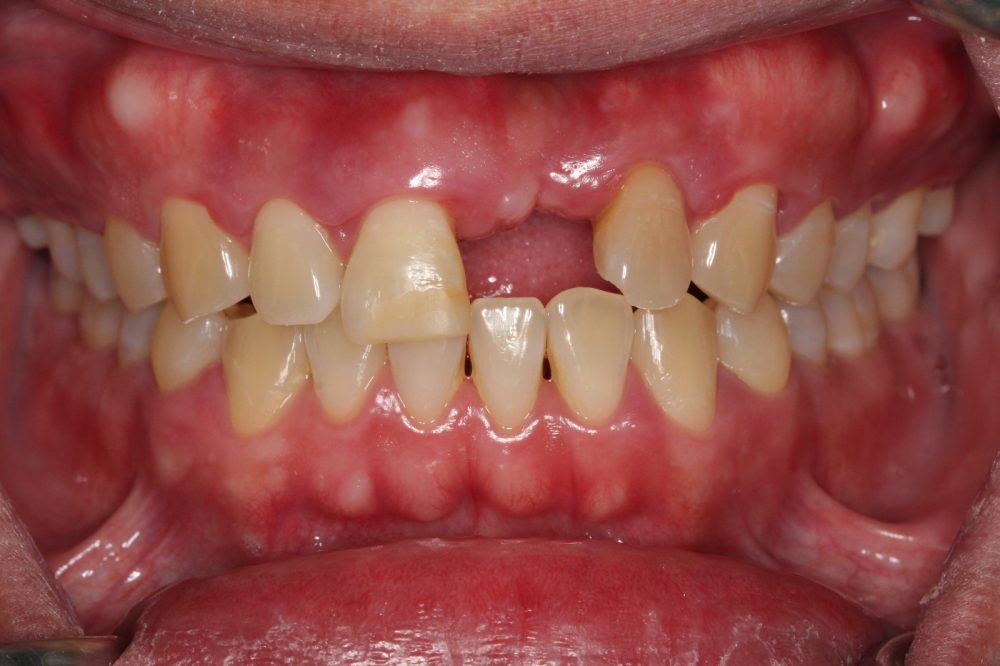 EMEA-Pre-restorative__Spacing__Tooth_prominence_case_after_1000x666